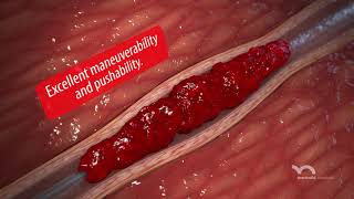 DClot HD Mechanical Thrombectomy System [upl. by Linetta]