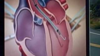 Impella 50 animation showing how it aids heart failure patients [upl. by Udelle]