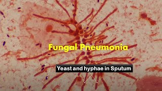 Heavy load of fungus in Sputum Microscopy [upl. by Anirtek720]