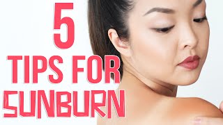 HOW TO Get Rid of Sunburn FAST [upl. by Arytas]