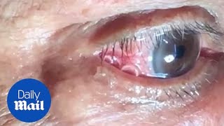 GRAPHIC Moment 15cm long worm is removed from mans eye [upl. by Ebonee]