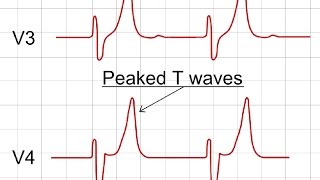 Hyperkalemia on ECG  ECG Findings of Hyperkalemia [upl. by Gnagflow]