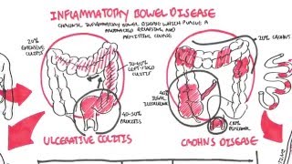 Inflammatory Bowel Disease  Crohns and Ulcerative Colitits [upl. by Hecht]