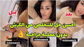 تقنية جديدة و مضمونة 💯 لإزالة ذهون البطن بدون جراحة 👌 Glamour Soukaina [upl. by Calder]