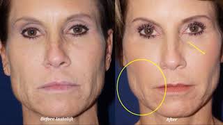 Instalift Nonsurgical Facelift Procedure [upl. by Noirod]