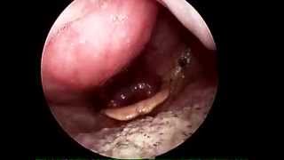 Videolaryngoscopy showing retopharyngeal abscess [upl. by Hildagarde]