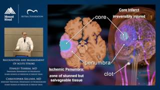 Recognition and Management of Acute Stroke [upl. by Iek810]