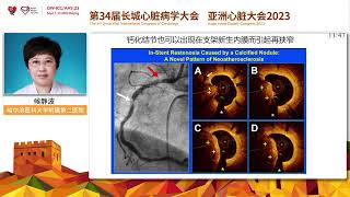 Role of Atherectomy in Calcified Nodules at GWICCAHS 2023 [upl. by Riabuz]