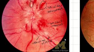 Papilloedema Fundoscopic Appearances [upl. by Oivlis915]