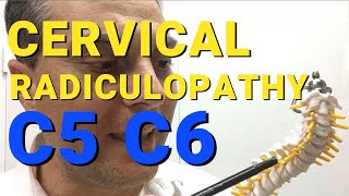 What Is C5 C6 Radiculopathy What Causes Cervical Radiculopathy Dr Walter Salubro [upl. by Sihonn675]