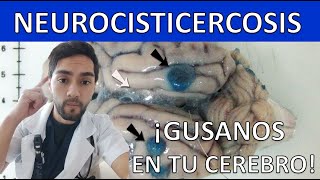 GUSANOS EN TU CEREBRO Neurocisticercosis Qué es Síntomas Diagnóstico Tratamiento Claro [upl. by Jemena]