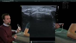 Elleboog  Common extensor tendon dwars  E14  echografie [upl. by Prichard144]