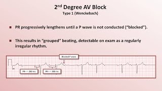 Intro to EKG Interpretation  AV Block [upl. by Otsirc648]