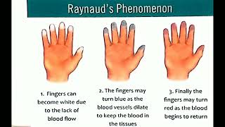 5 CT 👉 Systemic sclerosis by Dr Ahmed Nouh [upl. by Kcinnay624]