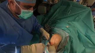 Operatie ligament  ACL surgery live [upl. by Ynnaj14]