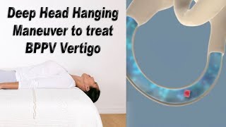 Deep Head Hanging Maneuver to Treat BPPV Vertigo [upl. by Nyrmac]