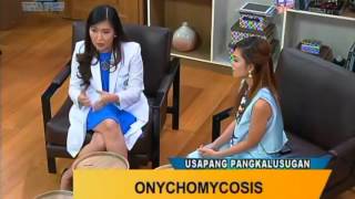 Good Morning Kuya Onychomycosis Fungal Nail Infection [upl. by Seale]