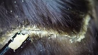 Dandruff scratching removal on head using black combing374 [upl. by Nuawd]