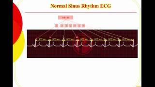 Sinus Arrhythmias [upl. by Adekahs]