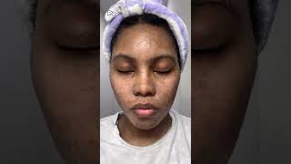 Client Video 🎥✨ MELANXPEEL PROCESS with touchedbytacha Check out touchedbytacha’s patient’s me [upl. by Navac277]