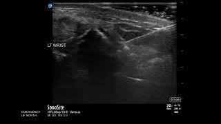 Wrist Ultrasound Distal Radius Fracture Hematoma Block [upl. by Eita530]