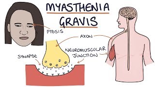 Myasthenia Gravis [upl. by Ahsrats711]