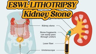 How to do Operation of Lithotripsy  ESWL Lithotripsy  Kidney Stone Treatment  Renal DJ Stent [upl. by Aicilyt]