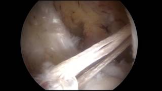 ACL Reconstruction with Single Bundle Hamstring Graft Graftlink [upl. by Smoht]