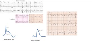 ST elevation on ECG part 2 case studies [upl. by Fransen]