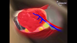 Minimally Invasive Total Thyroidectomy Video [upl. by Tymes]