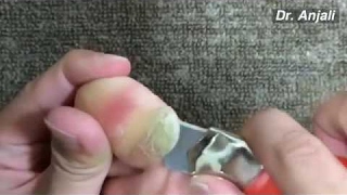 Removal Giant Calluses on Toes At Home [upl. by Ku]