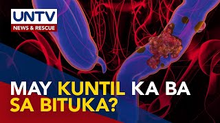 Pagkakaroon ng kuntil o polyps sa bituka posibleng mauwi sa colon cancer – expert [upl. by Eitsirk352]