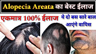 Alopecia Areata का बेस्ट ईलाज  Allopathic treatment of Alopecia Areata  Hair fall [upl. by Eicak894]