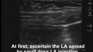 Rectus sheath block [upl. by Durwyn]