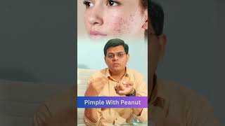 Kya Mongfali sy ACNE hoti ha peanuts fyp ytshorts skintalks acne [upl. by Elsy292]