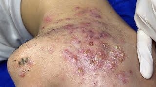 Big Cystic Acne Blackheads Extraction Blackheads amp Milia Whiteheads Removal Pimple Popping  9282 [upl. by Enailuj]