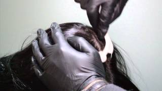 Mesotherapy  For Hair Regrowth and Hair Rejuvenation [upl. by Virgin151]