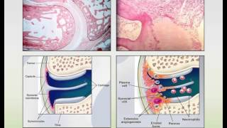 Rheumatoid Arthritis and Systemic Lupus Erythematosus Webinar [upl. by Ready834]