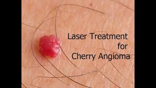 Cherry Angioma Laser Removal [upl. by Keeler]