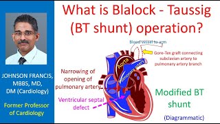 What is Blalock  Taussig BT shunt operation [upl. by Spense872]