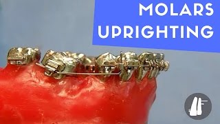 UPRIGHTING MOLARS [upl. by Gavin]