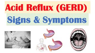 Gastroesophageal Reflux Disease GERD Signs amp Symptoms ex Bad Teeth  amp Why They Occur [upl. by Lamahj681]