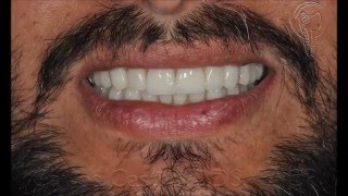 Full Mouth Reconstruction for worn down teeth  Atlanta GA [upl. by Elwee31]