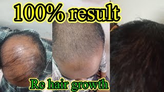 Re Hair growth treatment  बाल उगाणे का ट्रीटमेंट  hairgrowth hairtransformation [upl. by Guillemette128]