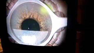 Step by Step Intralasik procedure for Monovision right eye of patient Sandy [upl. by Fedak]