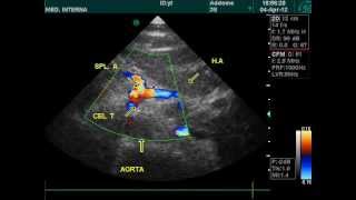 optimal view of celiac trunk and left renal vein doppler vascular ultrasound wmv [upl. by Sascha97]