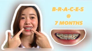 Braces Underbite  7 Months l PH [upl. by Ahsetra]