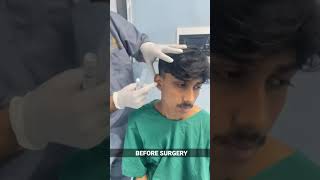 Bat Ear Correction under Local Anesthesia  Otoplasty in India  Before Surgery shorts [upl. by Gnex138]