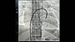 Successful Percutaneous Mitral Balloon Valvotomy of Patient With Tight Mitral Stenosis [upl. by Nicodemus843]