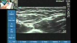 How to find nerves for axillary block [upl. by Ynnaf972]